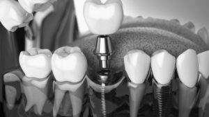 Monashee Dental Centre - Dr Paula Winsor-Lee - Lumby BC - Page Hero - Dental Implants